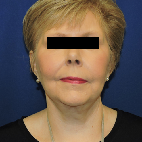 Patient 06, view 1 view after neck lift
