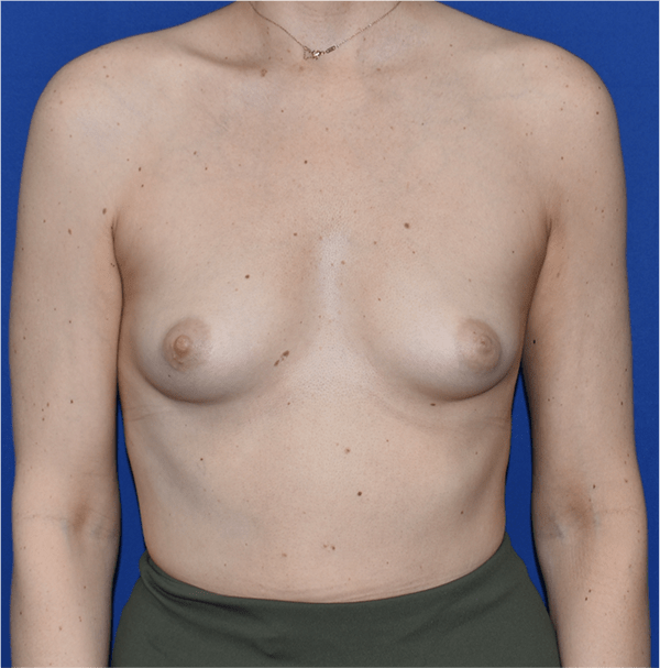 Patient 66, view 1 view before breast augmentation