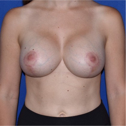 Patient 06, view 1 view after breast augmentation with lift