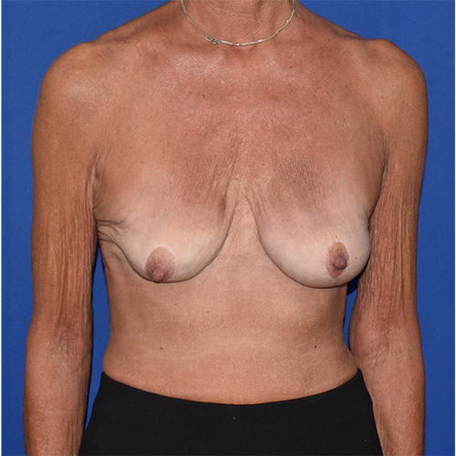 Patient 13, front view after implant removal