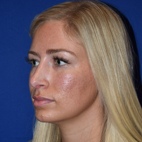 Patient 13, view 1 view after rhinoplasty