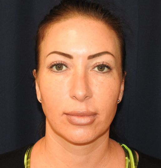 Patient 23, view 1 view after rhinoplasty