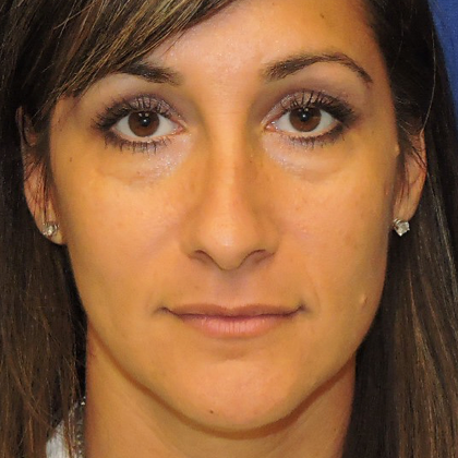 Patient 10, view 1 view before blepharoplasty