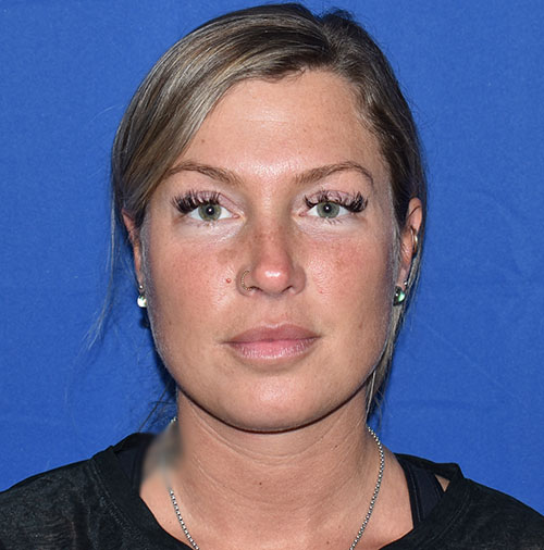 Patient 20, view 1 view after chin liposuction