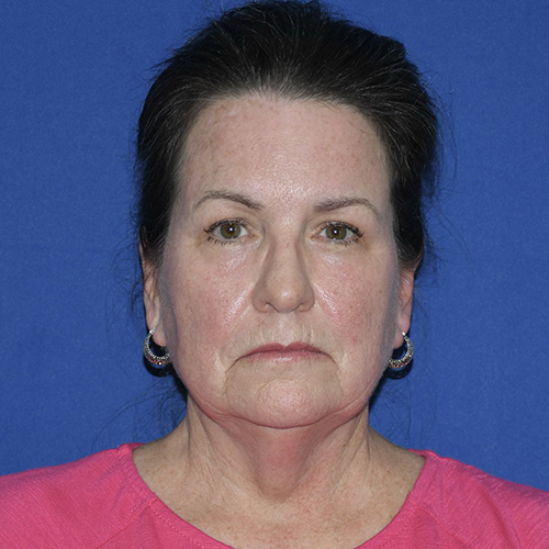 Patient 06, front view before facial fat grafting