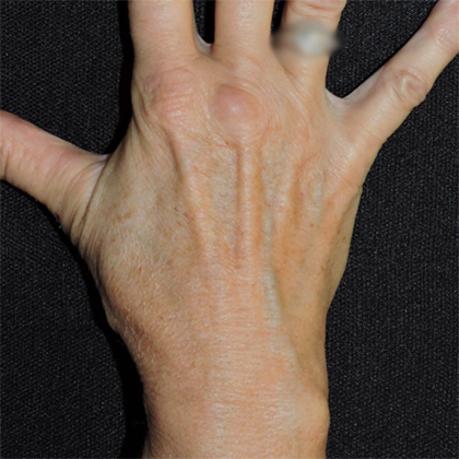 Patient 03, view 1 view before hand rejuvenation