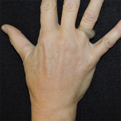 Patient 03, view 1 view after hand rejuvenation