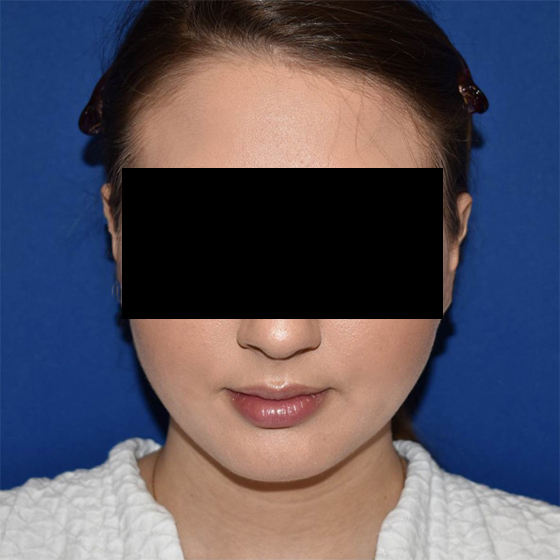 Patient 18, view 1 view before chin liposuction