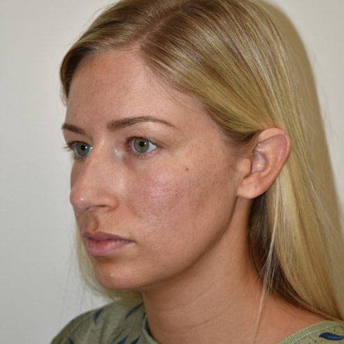 Patient 13, view 1 view before rhinoplasty