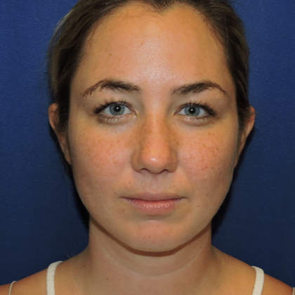 Patient 15, view 1 view after chin liposuction