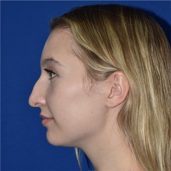 Patient 06, view 1 view before rhinoplasty