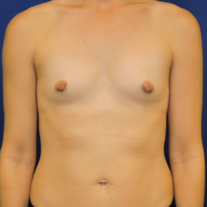 Patient 10, view 1 view before mini breast augmentation