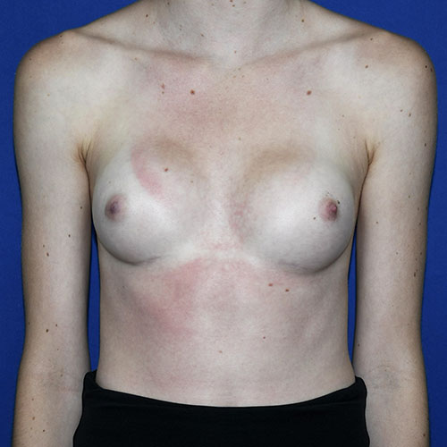 Patient 04, front view after mini breast augmentation