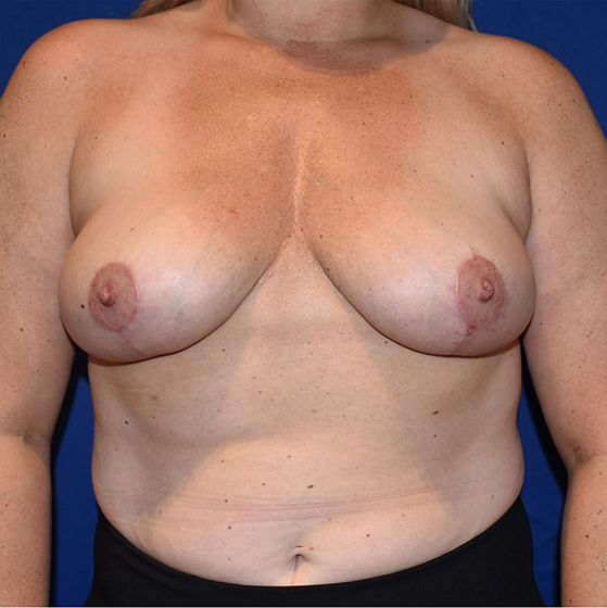 Patient 09, view 1 view after breast reduction