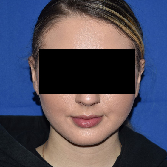 Patient 18, view 1 view after chin liposuction