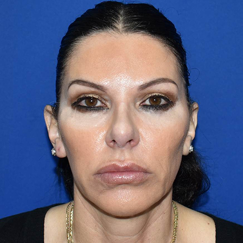 Patient 01, view 1 view after lip augmentation/lip implant