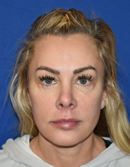 Patient 32, view 1 view after facelift