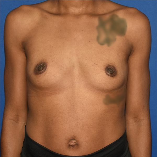 Patient 87, view 1 view before breast augmentation