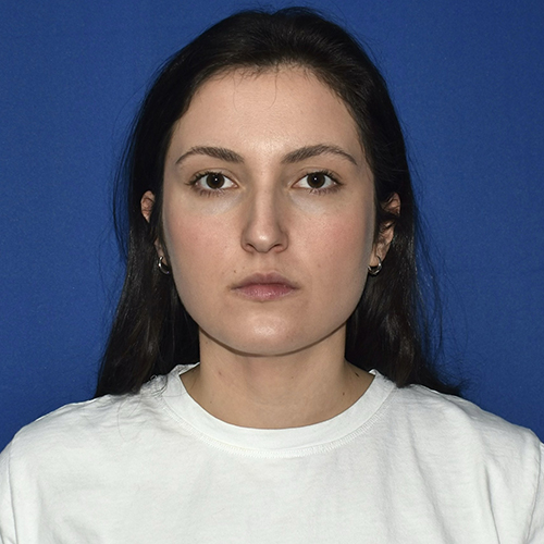 Patient 21, front view after chin liposuction