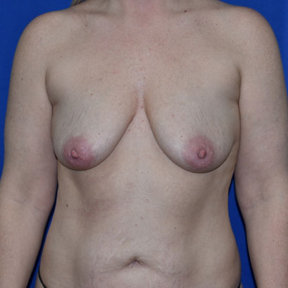 Patient 09, view 1 view before breast augmentation with lift