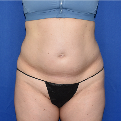 Patient 01, front view before tummy tuck