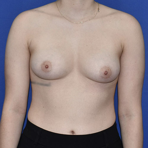 Patient 21, front view before breast augmentation