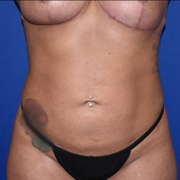 Patient 14, view 1 view after liposuction