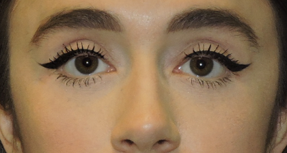 Patient 04, view 1 view after blepharoplasty