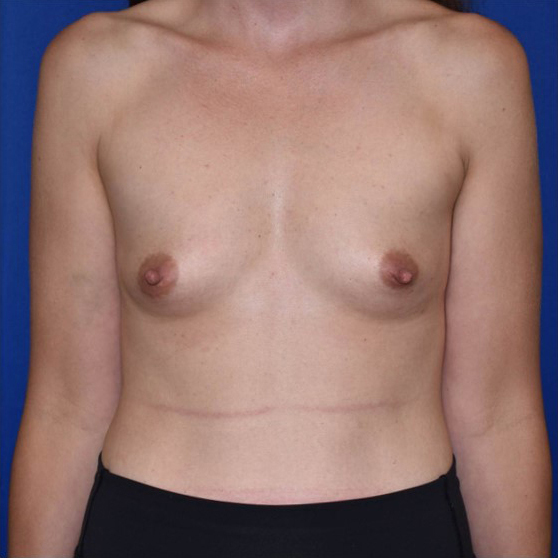 Patient 84, view 1 view before breast augmentation