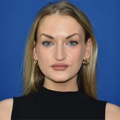 Patient 05, front view before rhinoplasty