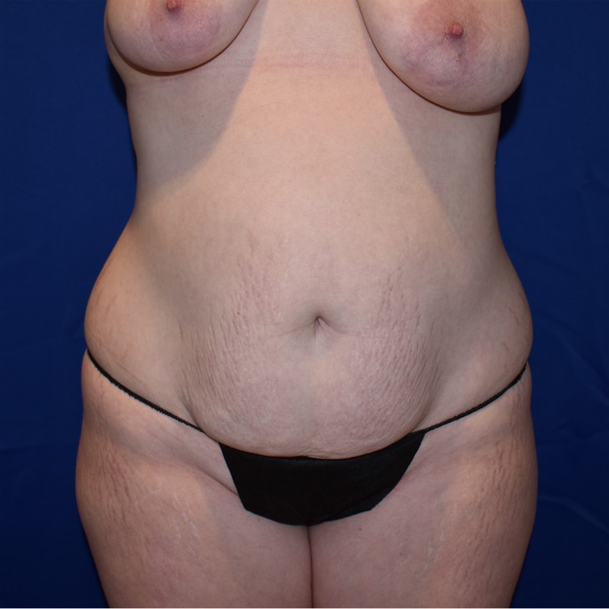 Patient 08, view 1 view before tummy tuck