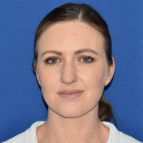 Patient 36, view 1 view before rhinoplasty