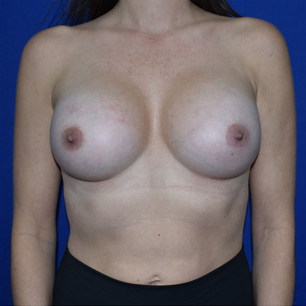 Patient 85, view 1 view after breast augmentation