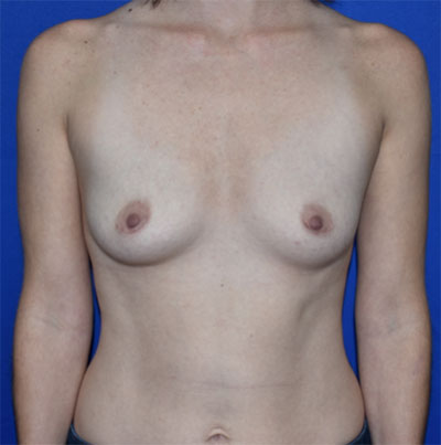 Front view before breast augmentation