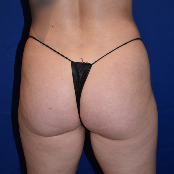 Patient 16, view 1 view before brazilian butt lift