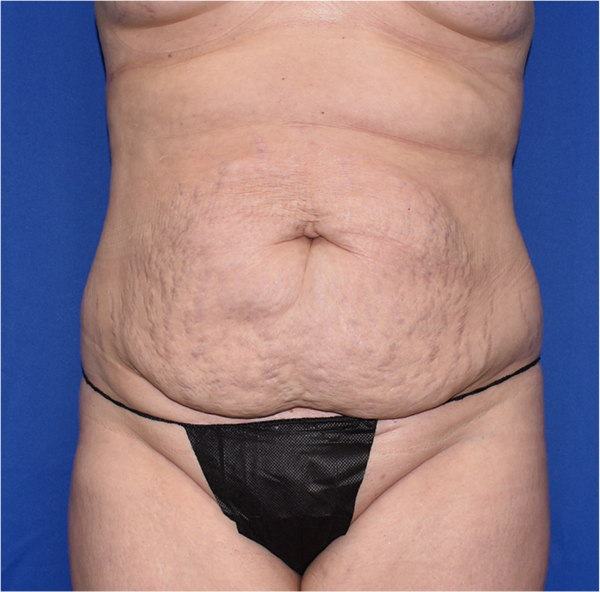Patient 34, view 1 view before tummy tuck