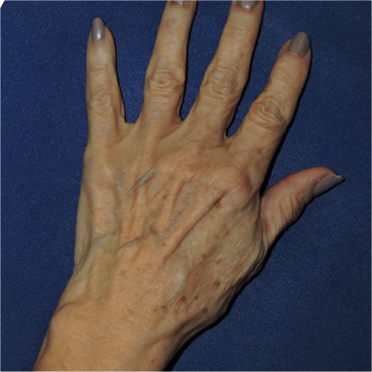 Selected view before hand rejuvenation