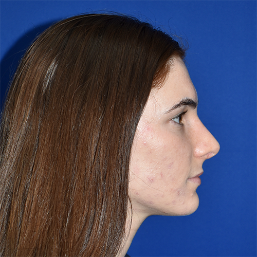 View 3 after rhinoplasty