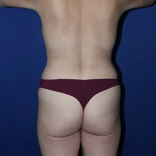 Patient 15, view 1 view before brazilian butt lift