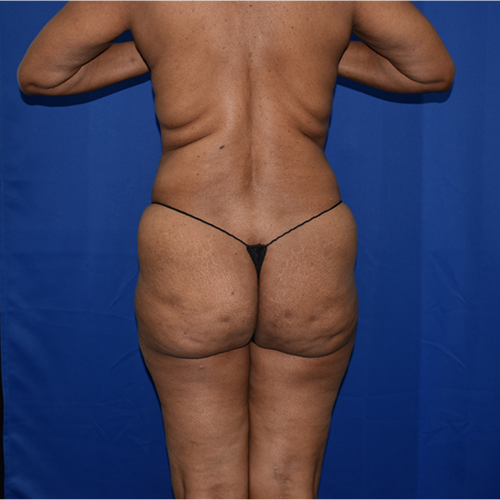 Patient 18, view 1 view before brazilian butt lift