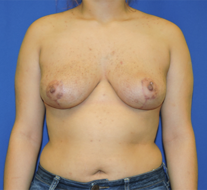 Patient 13, view 1 view after breast reduction