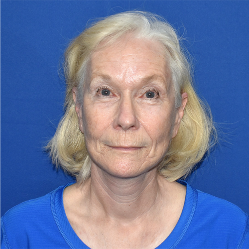 Patient 16, view 1 view after facelift