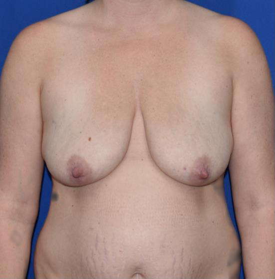 Patient 11, view 1 view before breast lift