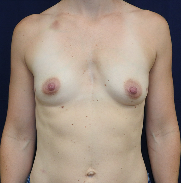 Patient 117, view 1 view before breast augmentation
