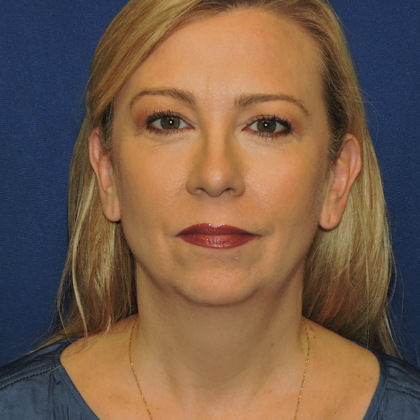 Patient 03, view 1 view before chin augmentation