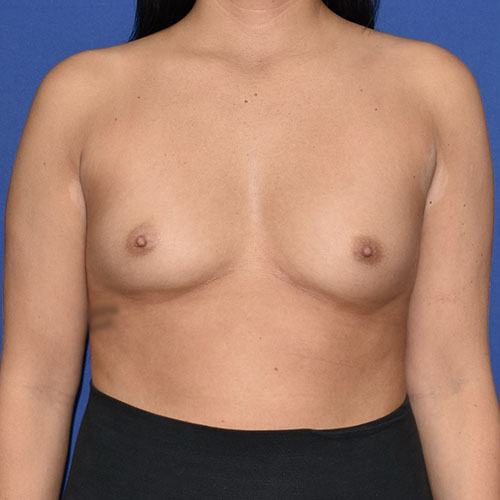 Patient 15, front view before breast augmentation