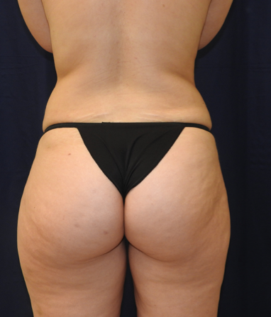 Patient 20, view 1 view after liposuction