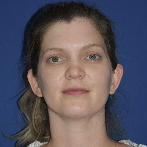 Patient 04, front view after chin liposuction