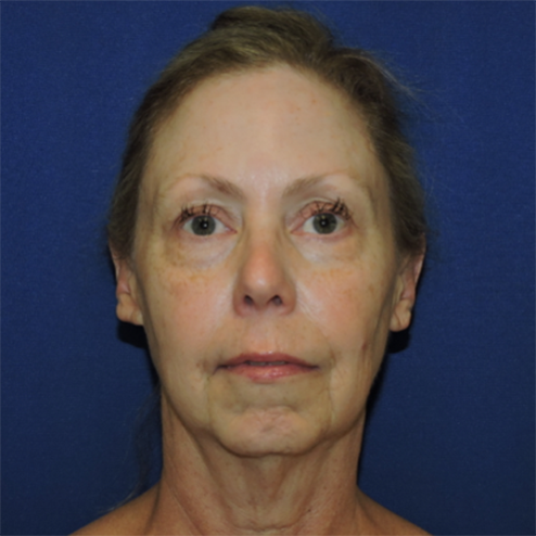 Patient 04, view 1 view before neck lift
