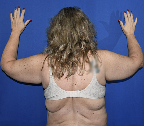 Patient 11, view 1 view before arm lift